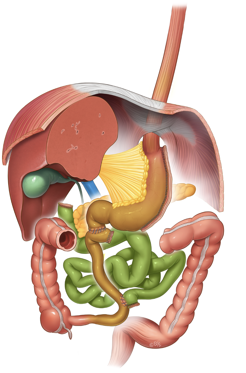 Medical illustration: BPD/DS