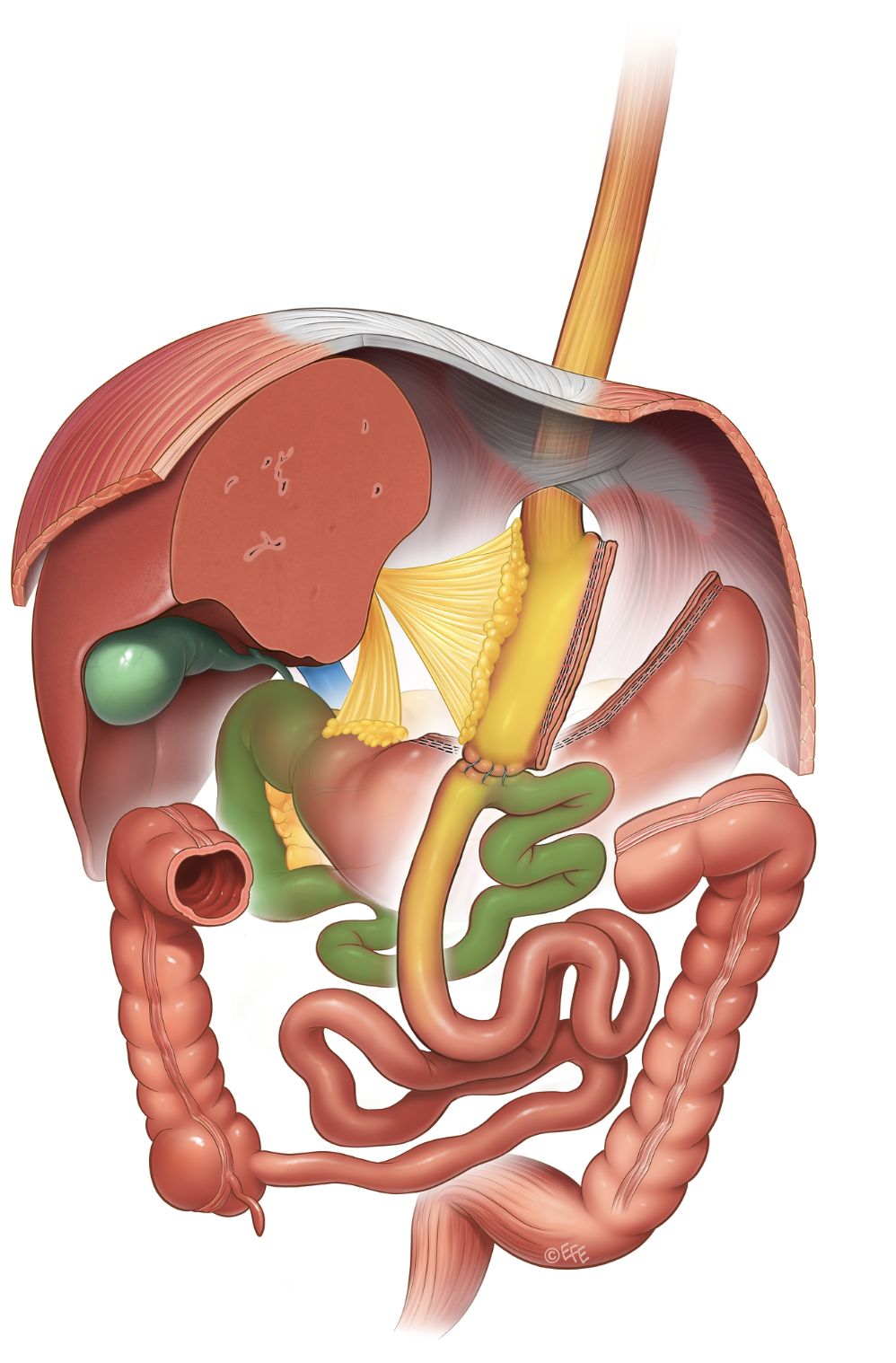 Medical illustration: Omega-Loop Bypass (OAGB)