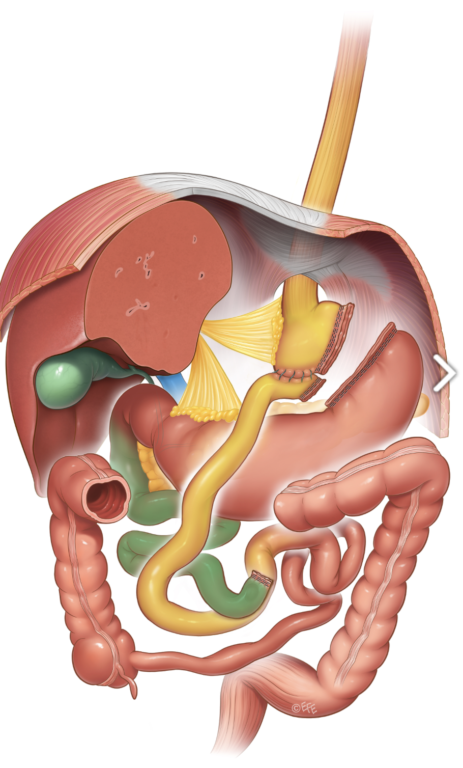 Medical illustration: SADI-S