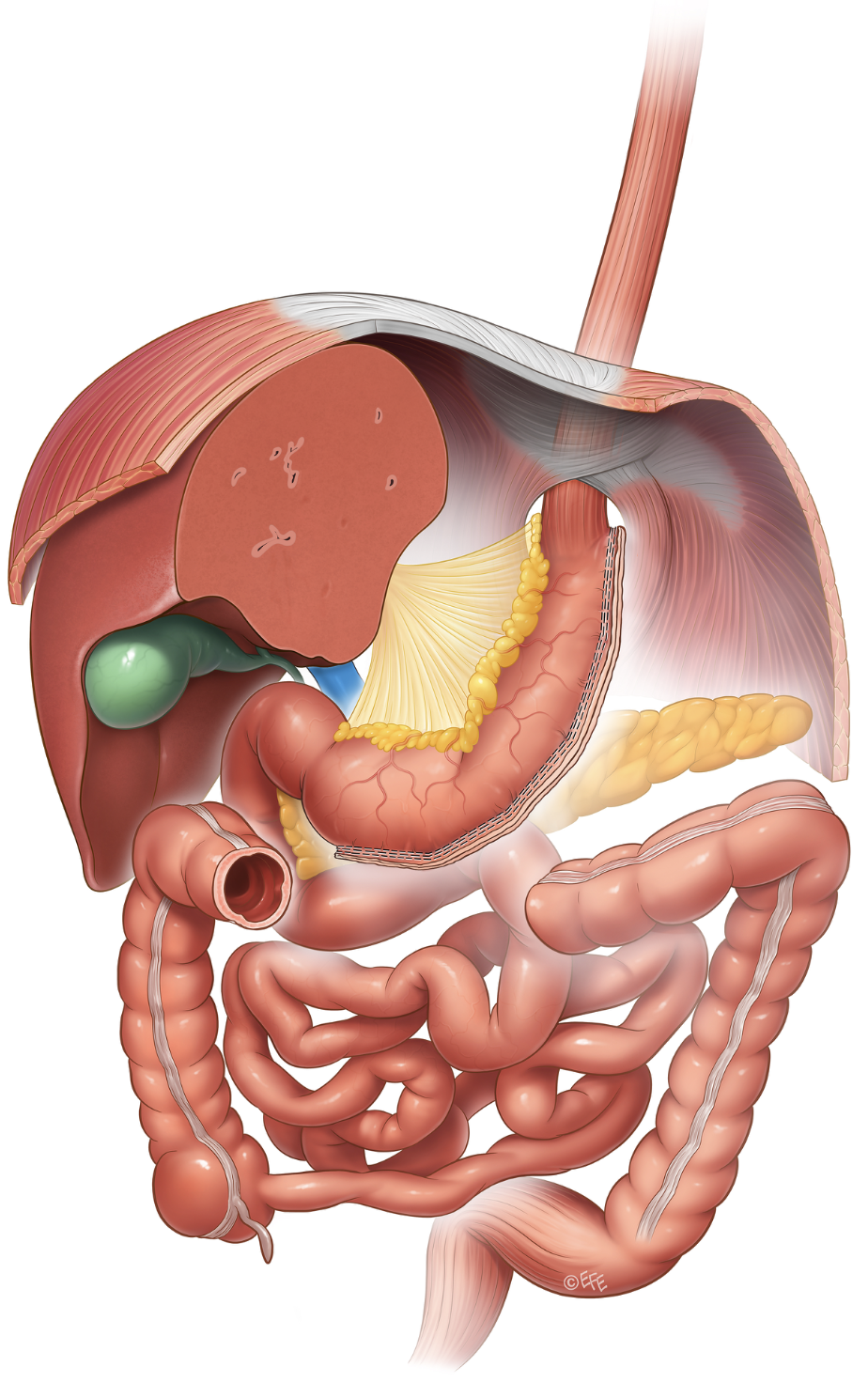 Medical illustration: Sleeve Gastrectomy