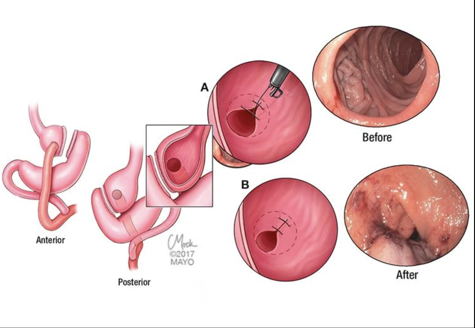 Medical illustration: Transoral Outlet Reduction