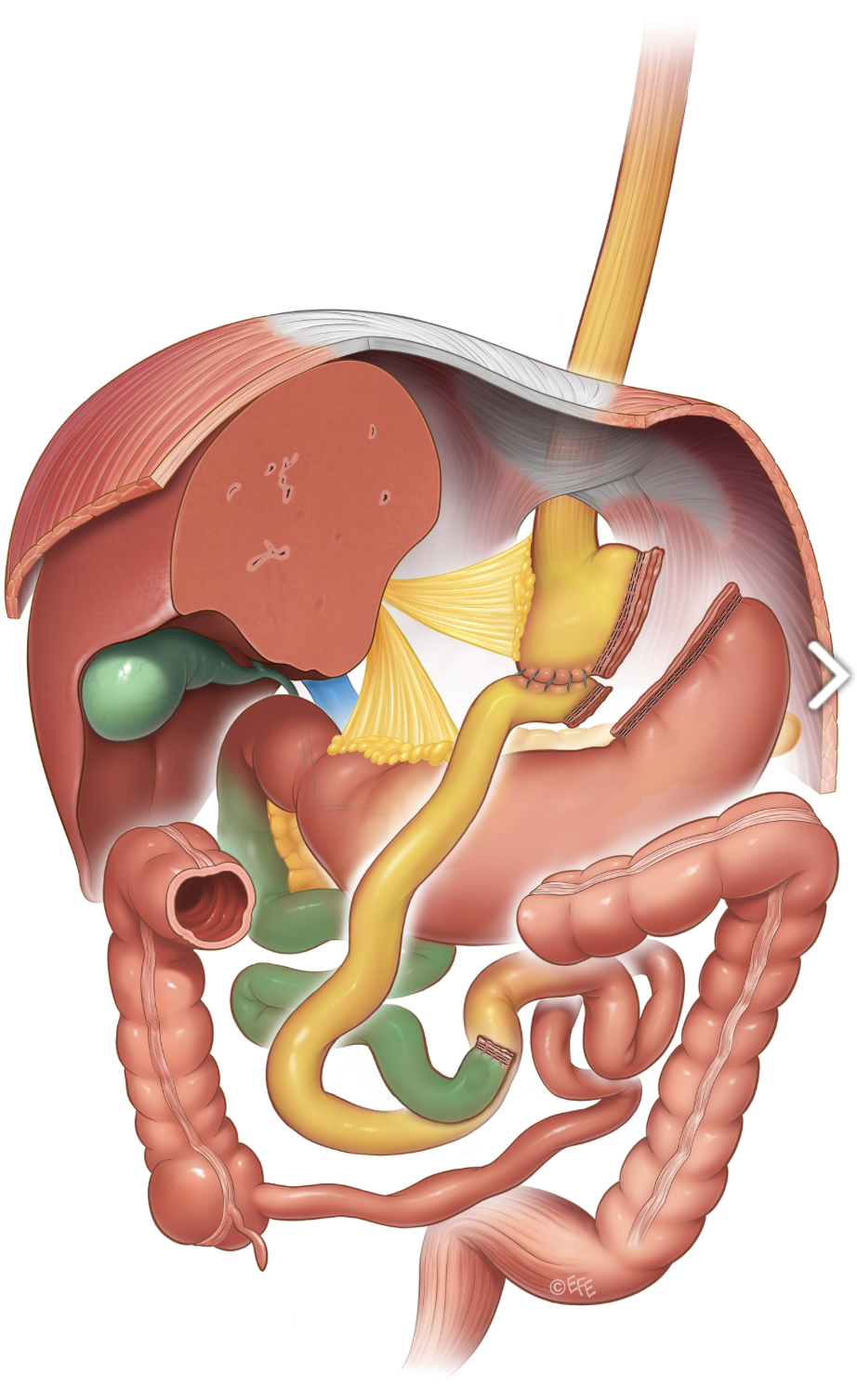 Medical illustration: Roux-en-Y Gastric Bypass