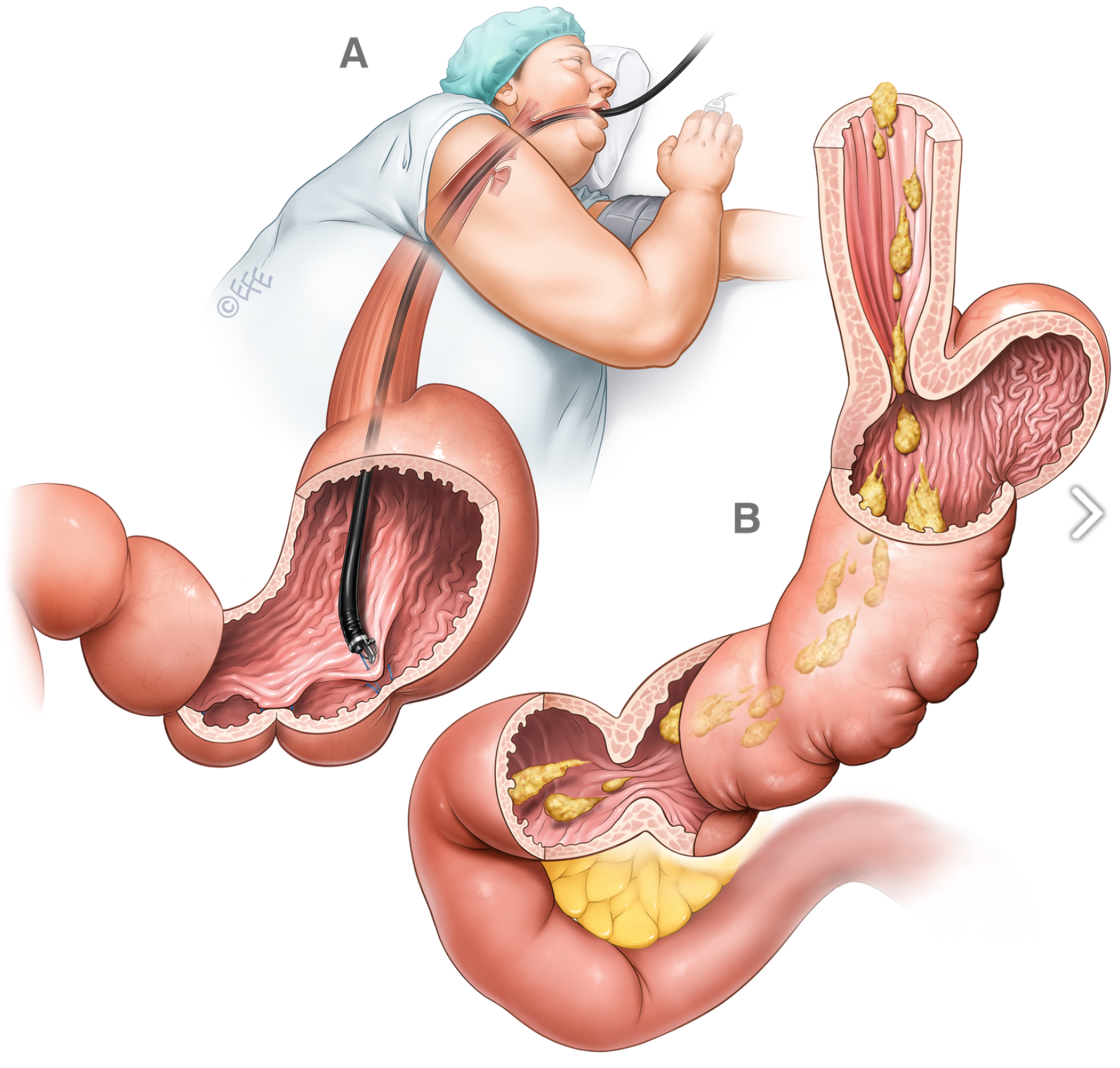 Medical illustration: Endoscopic Sleeve Gastroplasty