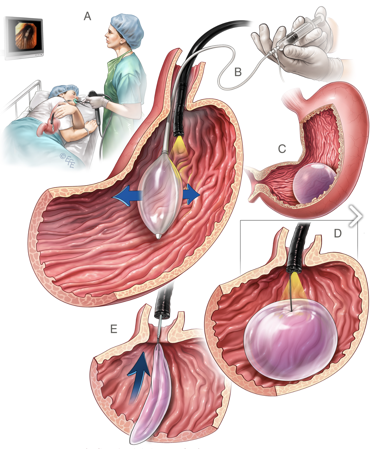 Medical illustration: Gastric Balloon